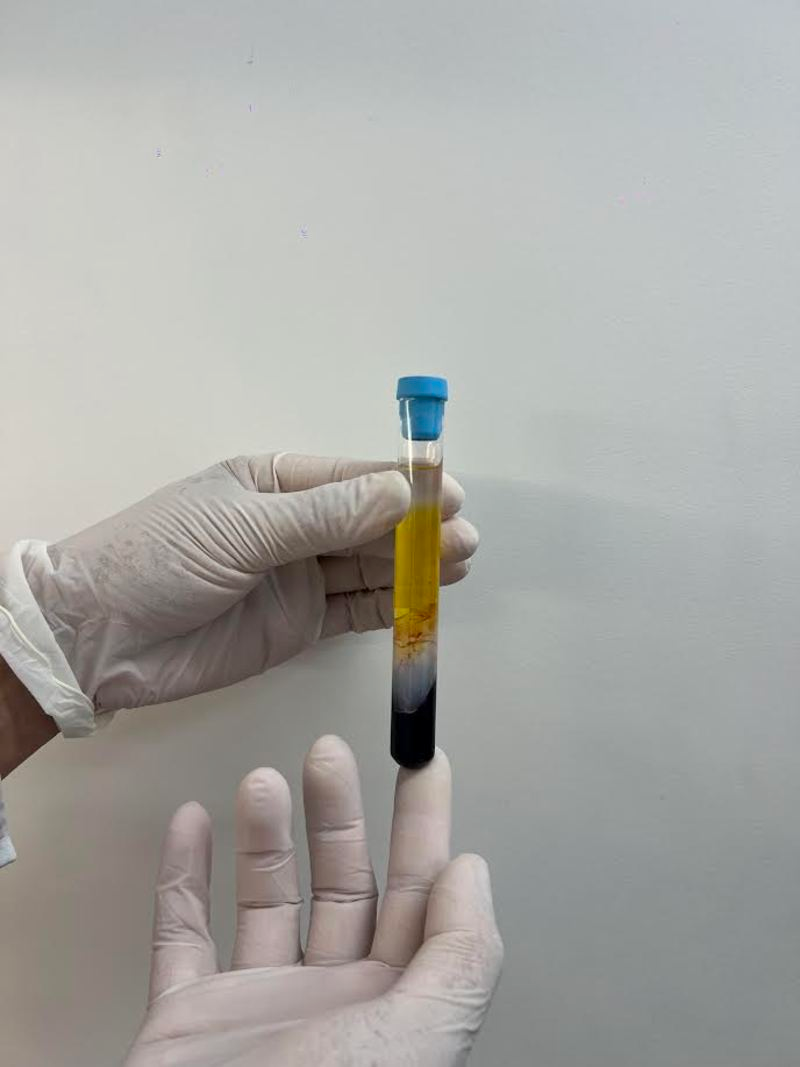 CFM regulamenta PRP em condi&ccedil;&otilde;es osteomusculares